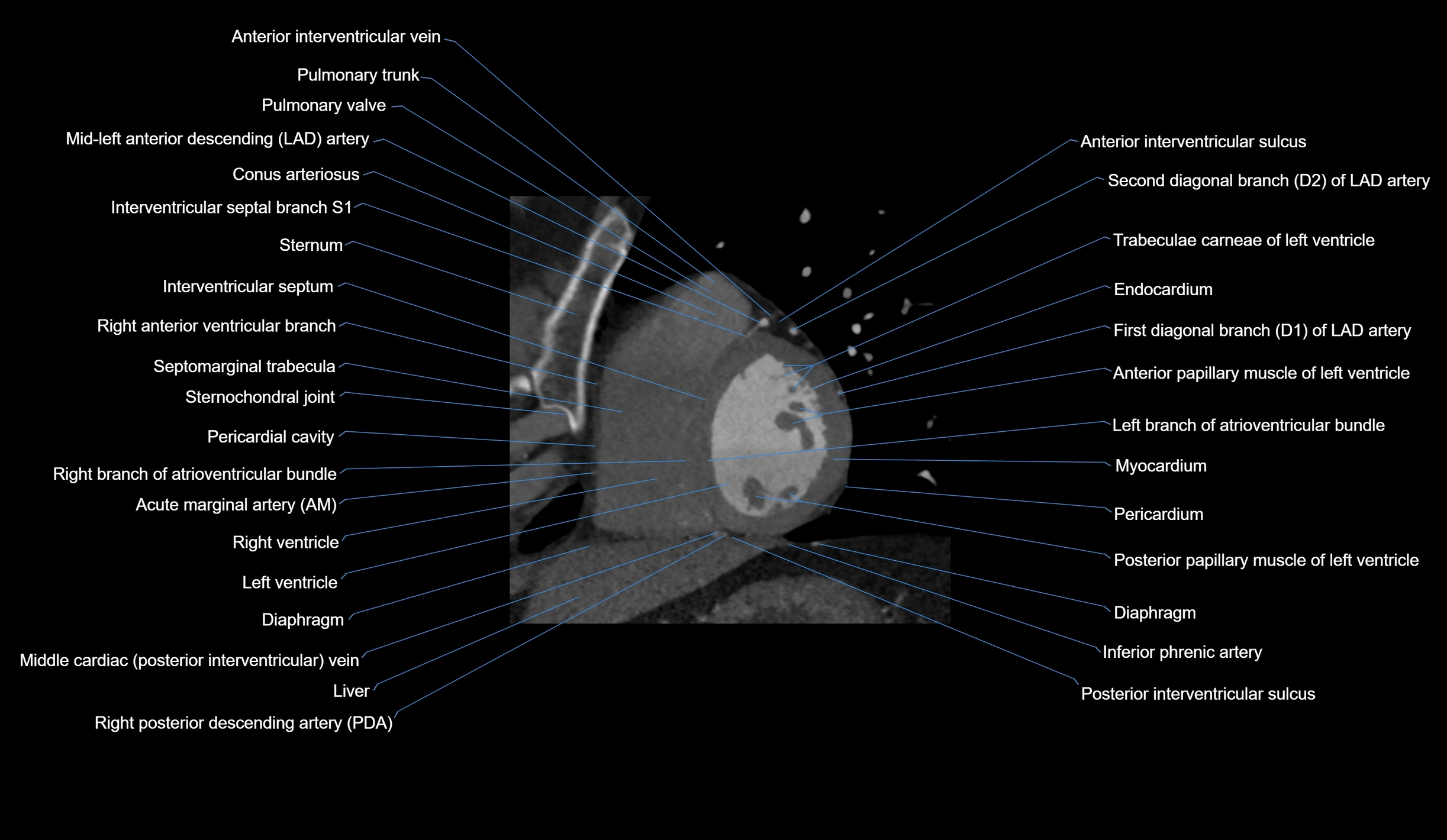 CT heart (coronary angiogram) short axis view  cross sectional anatomy labelled radiology image-00033.webp